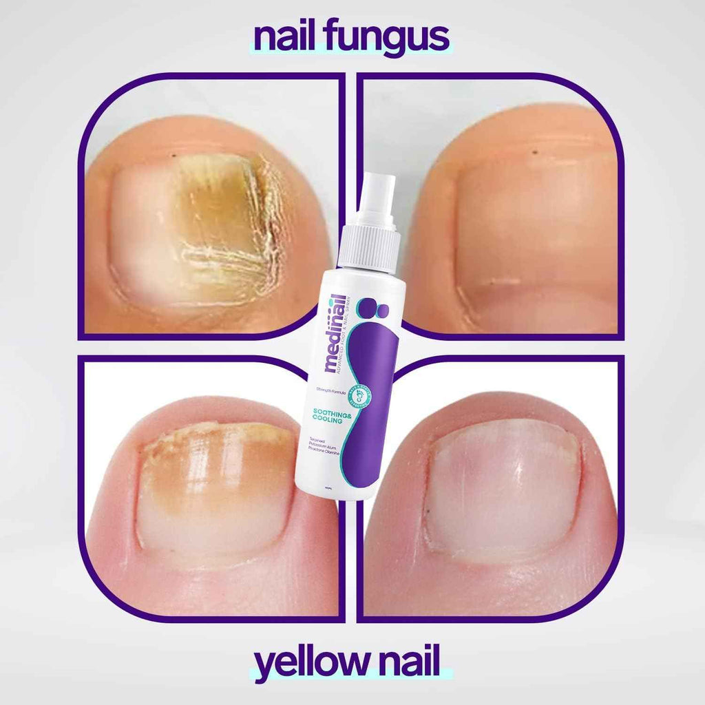 Medinail Nail Fungus Treatment Spray - 7 Day Anti-Fungal Nail Care ( 100ml ) - The Riyadh Store