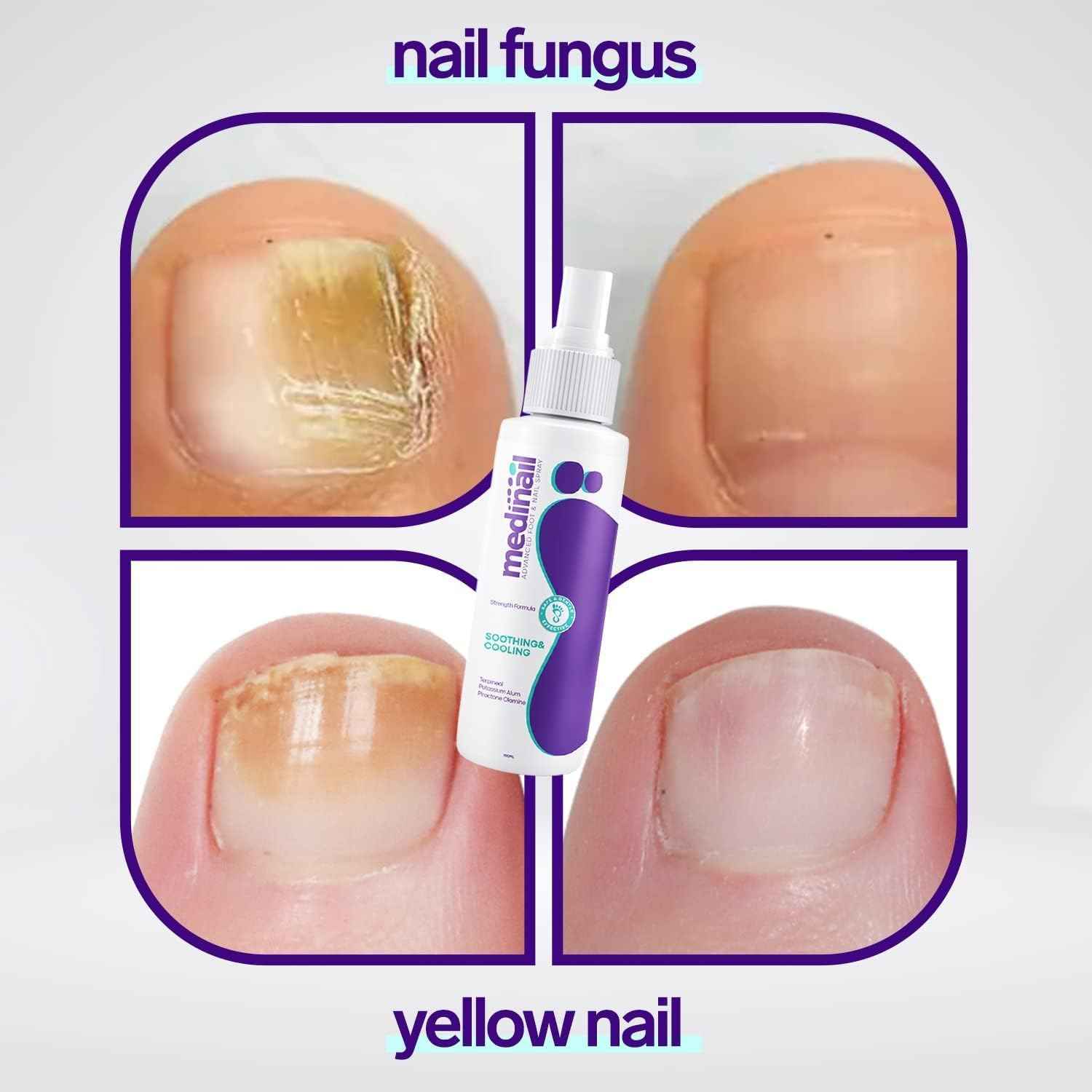Medinail Nail Fungus Treatment Spray - 7 Day Anti-Fungal Nail Care ( 100ml ) - The Riyadh Store